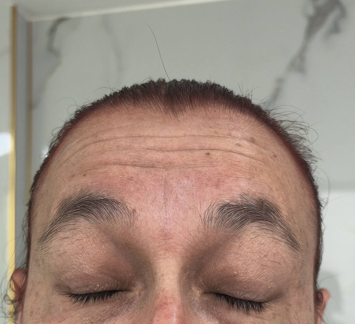 Antes — arrugas de expresión frente