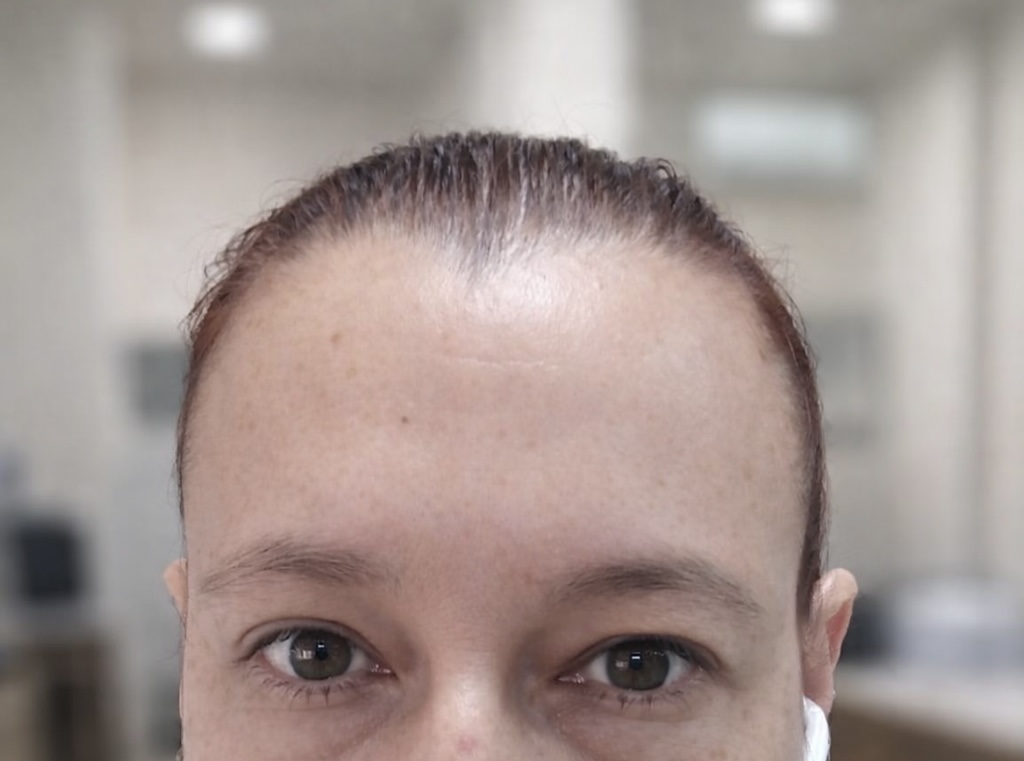 Después — frente relajada post toxina