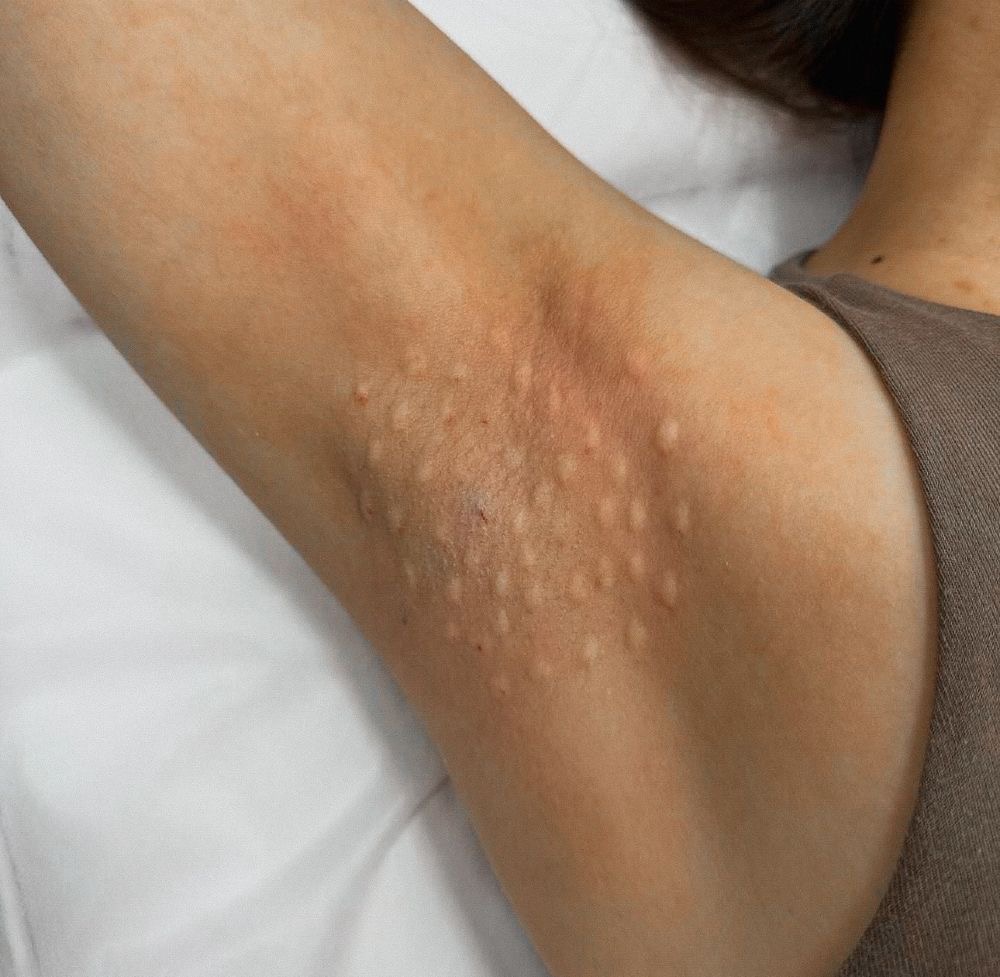 Bótox axilar — procedimiento hiperhidrosis